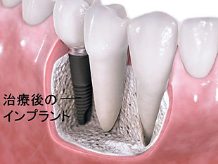 岡田歯科 インプラント.jpg
