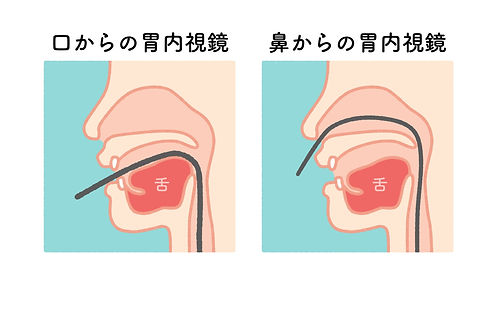 内視鏡イメージ