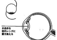 白内障