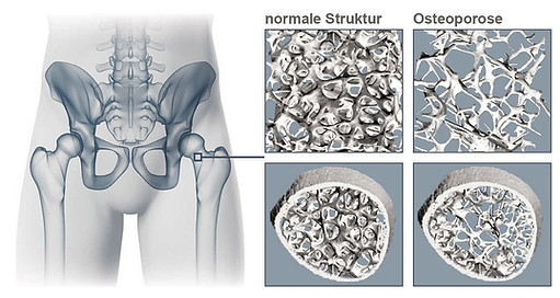 Osteoporose Struktur