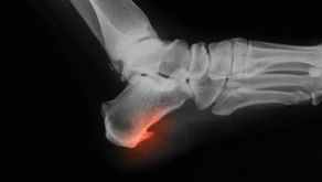 Heel Spur Treatment Options
