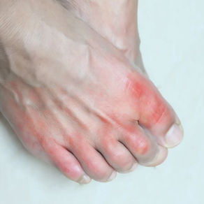 Gout in the Big Toe: Early Signs and Signals