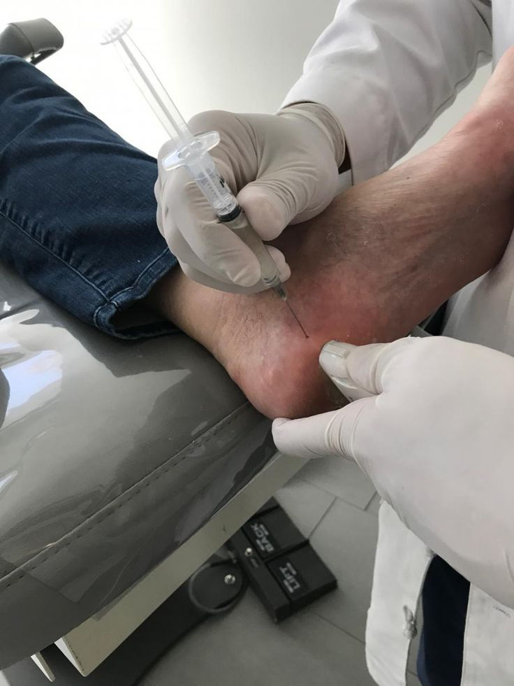 What to Expect With Heel Injection Therapy