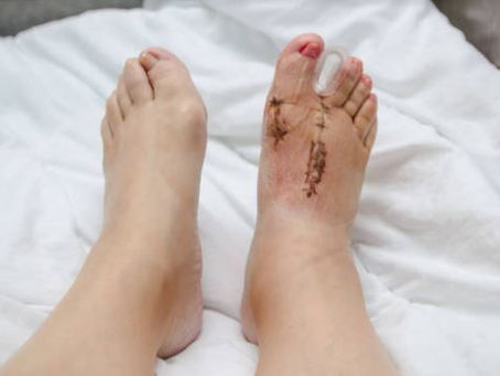 Bunion Surgery: What to Expect Every Step of the Way