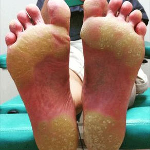 Corns vs Calluses: Care and Prevention