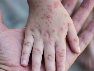 Casos de sarampión “foráneos” importados desde el estado de Chihuahua