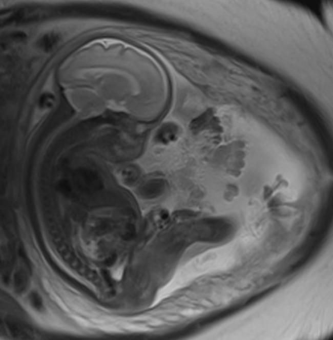 The Collapse of the Gazan Healthcare System and its Impact on Pregnant Women.