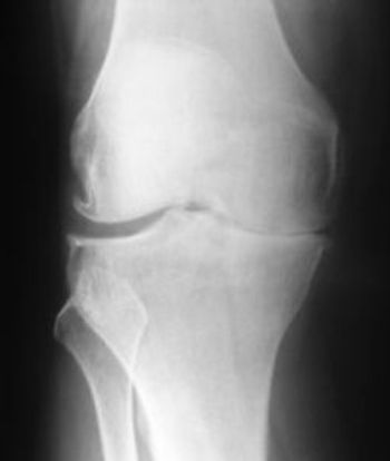 New Age Therapy, daniel jackson, Arthritic Pain, Arthritis, yorkshire, wakefield, pontefract, castleford, normanton, hypnotherapy, stiffness