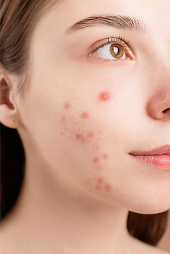 acne.png