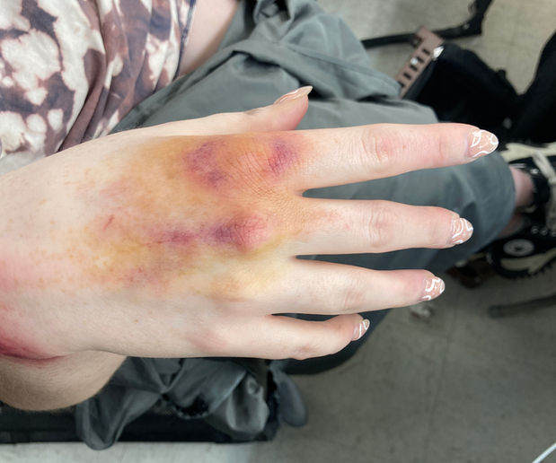 old bruise simulated with makeup