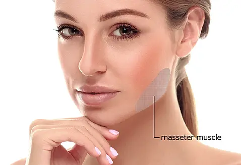 masseter treatment at Rinse Dental