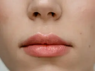 Top 5 Lip Filler Providers in Waco for 2025