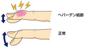 ヘバーデン(wix).PNG