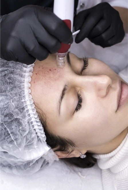 PRP facial also known as vampire facial