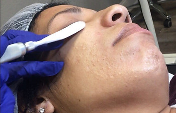 Dermaplaning for Skin Austin - Beauty Spa, Scar Camouflage, Microneedling, Botox, Fillers, Skincare, Medical Tattooing, Hair Loss Micropigmentation, in Round Rock, TX