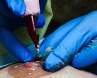 3D Areola Restoration - Breast Cancer Scars Cover Up -Beauty Spa, Scar Camouflage, Microneedling, Botox, Fillers, Skincare, Medical Tattooing, Hair Loss Micropigmentation, in Round Rock, TX