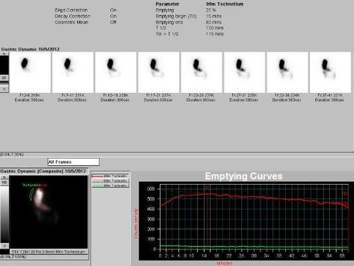 Gastric Emptying in Situs Inversus