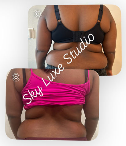 Visible refinement after four sculpting sessions—an elegant beginning to a transformative journey.