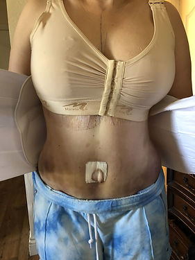 Day after surgery_.jpg