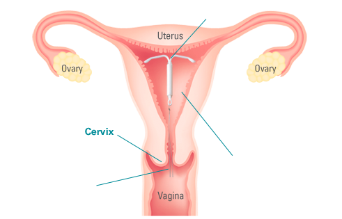 The Complete Guide To Getting An Iud