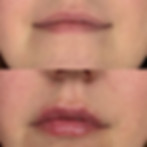 lipBeforeAfter.jpg