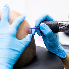 Präzise Kopfhaut-Micropigmentierung durch spezialisiertes Team im Permanent Make-up Studio Hamburg.