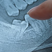 Qingpu impacted wisdom teeth