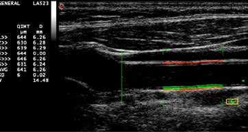 QIMT examination. Far-wall CCA IMT is automatically measured within the ROI (green rectangle). The values of IMT and diameter (D) are displayed beat-to-beat on the screen, and the mean value (AVG) over the last 6 beats and standard deviation (SD) are continuously calculated