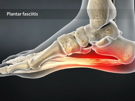 5 שיטות לניהול דלקת פלנטרית (Plantar Fasciitis) – על פי ההנחיות המעודכנות של 2025