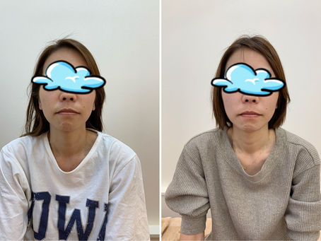 小顔矯正!!
