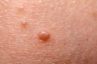 Molluscum Contagiosum Water Warts

