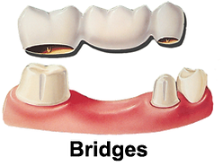 Dental bridge