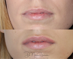 Lippenunterspritzung vorher nachher