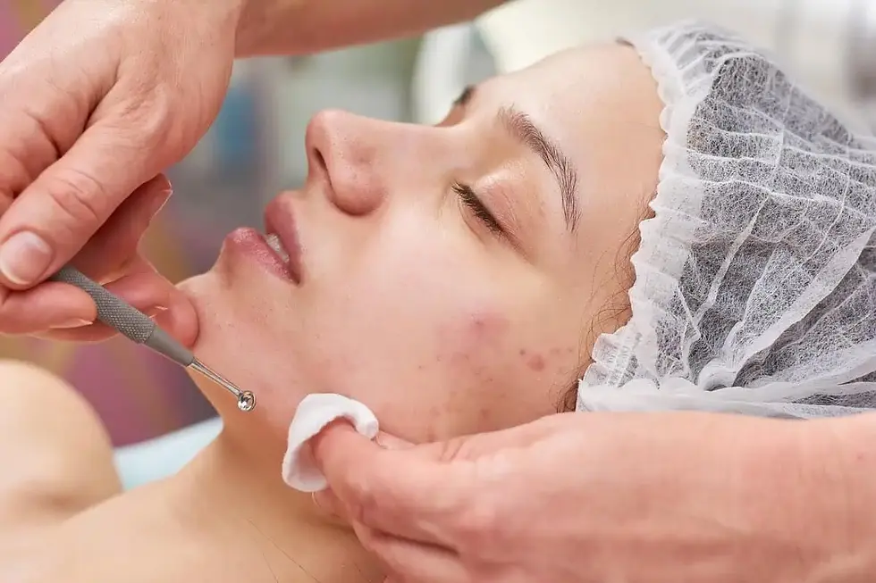 Best acne treatment Melbourne before and after results