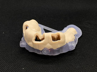 Ghid Chirurgical, All on 6, Implant Ghidat