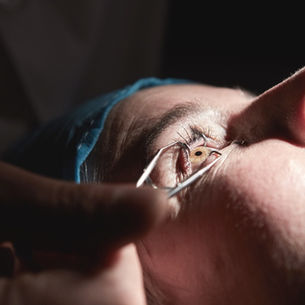 Clarifying Your Cataract Conundrums 