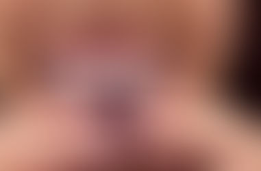 Entenda o que é invisalign e quais as suas vantagens