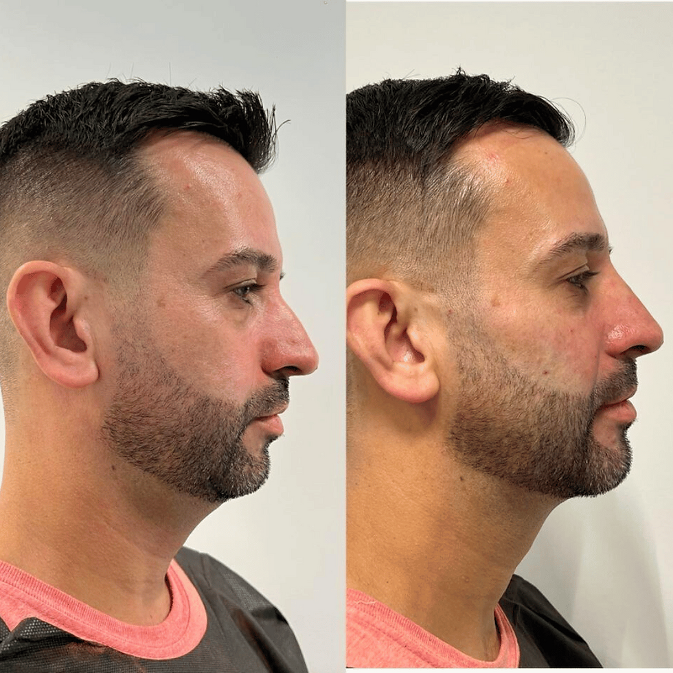Harmonização facial masculina – homem com barba, camiseta rosa