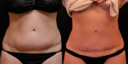 laser-liposuction-before-after-new-jerse