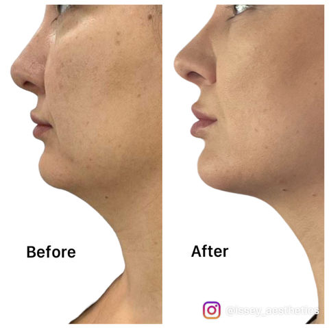 Fat dissolving injections before and after results, Sunshine Coast QLD, Noosa, Marcoola. Best fat dissolving results, under chin, submental. Cosmetic treatments, botox and fillers. Neck treatments, neck skin tightening, anti-ageing treatmetns, double chin dissolving