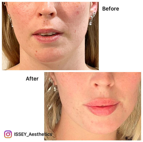 Lip filler before and after result Sunshine Coast QLD, Noosa, Coolum, Marcoola, best natural looking results, Botox and fillers before and after results, anti-ageing cosmetic treatment results, antiwrinkle injections and dermal fillers, skin treatments and collagen induction, dysport treatment and dermal fillers, natural looking lip filler