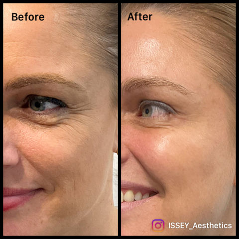 Profhilo, Profhilo Structura, Rejuran, Botox and fillers before and after results, Sunshine Coast QLD, Noosa, Marcoola. Anti-ageing cosmetic treatment results, antiwrinkle injections and dermal fillers, skin treatments and collagen induction, crow’s feet dysport treatment, bioremodelling and cheeks volumising, microneedling. 