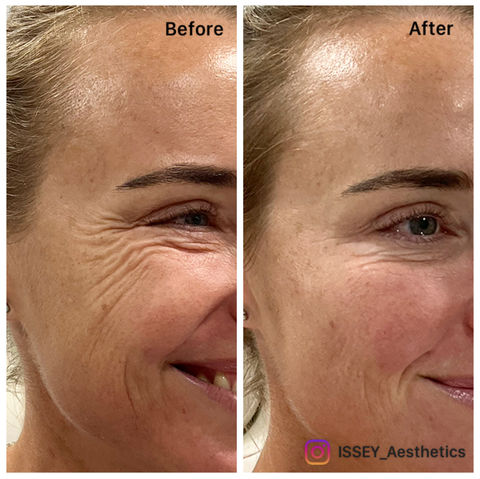 Profhilo, Profhilo Structura, Rejuran, Botox and fillers before and after results, Sunshine Coast QLD, Noosa, Marcoola. Anti-ageing cosmetic treatment results, antiwrinkle injections and dermal fillers, skin treatments and collagen induction, crow’s feet dysport treatment and cheek volumising. 