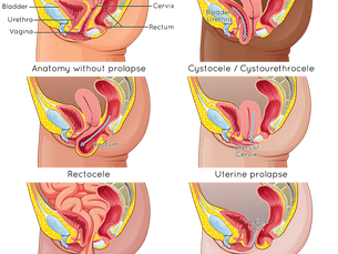 Pelvic Organ Prolapse: What It Is, Symptoms, Causes & Treatment