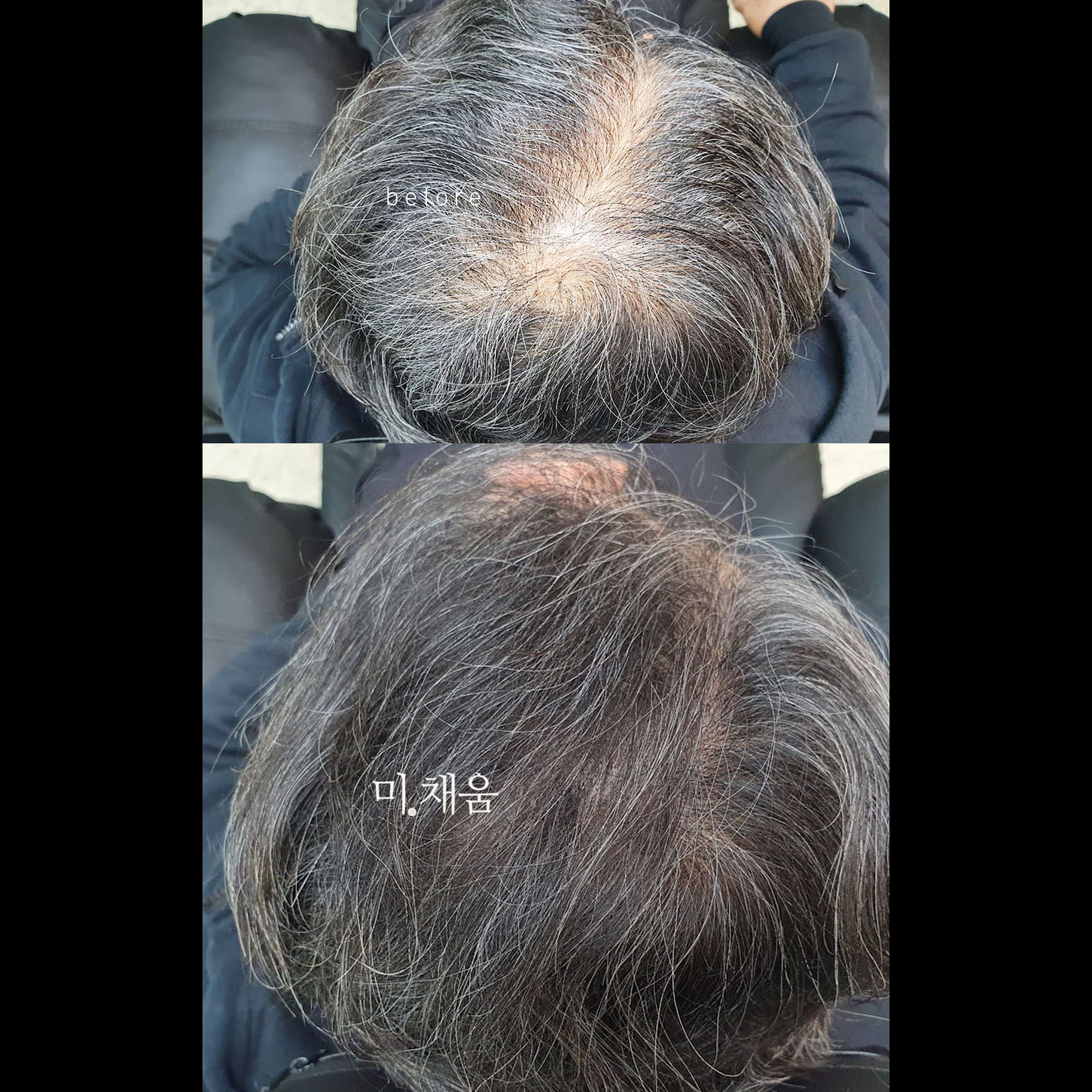 청량리 두피문신, 동대문구 두피문신, 강북 두피문신, 노원 두피문신, 건대 두피문신, 서울 두피문신, 동대문 두피문신, 미채움 두피문신