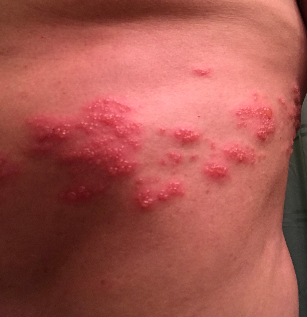 Early stages of the infection