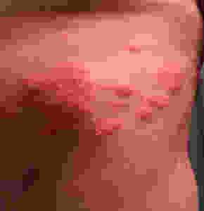 Early stages of the infection