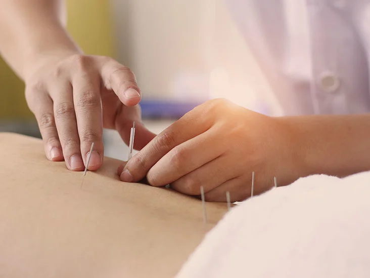 Acupuncture