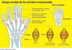 La artritis reumatoide afecta tu calidad de vida