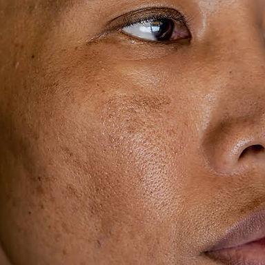 melasma.jpg